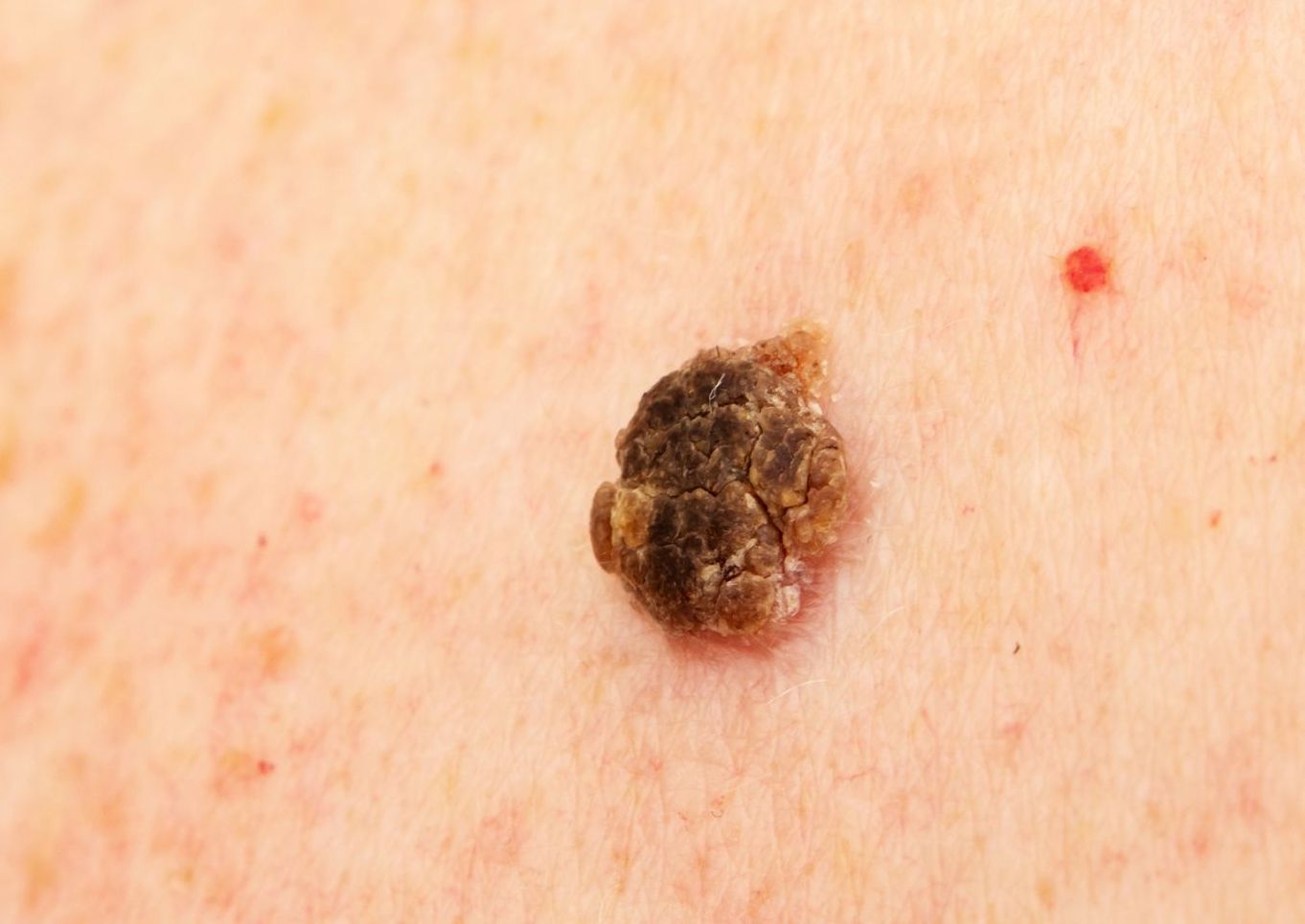 closeup of Seborrheic Keratosis on white patient skin