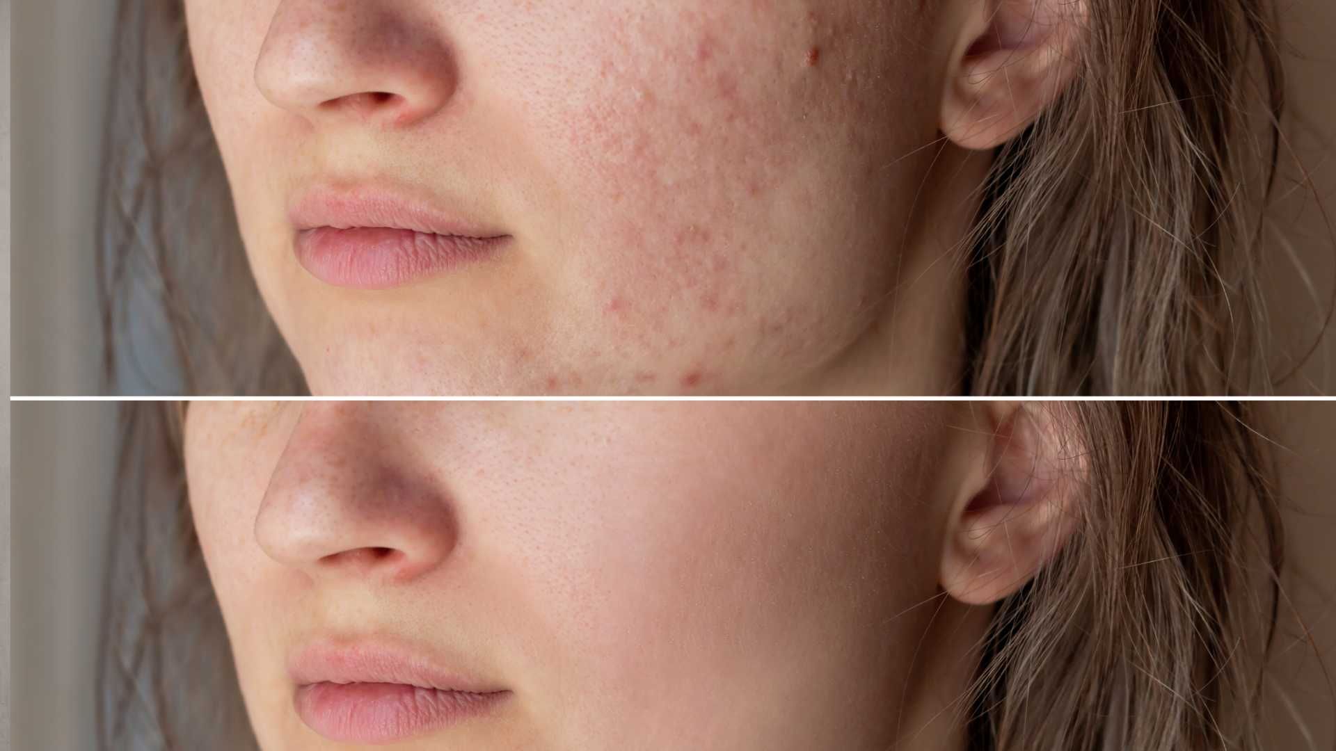 Close-up comparison of a woman's cheek and mouth before and after skin treatment, split horizontally
