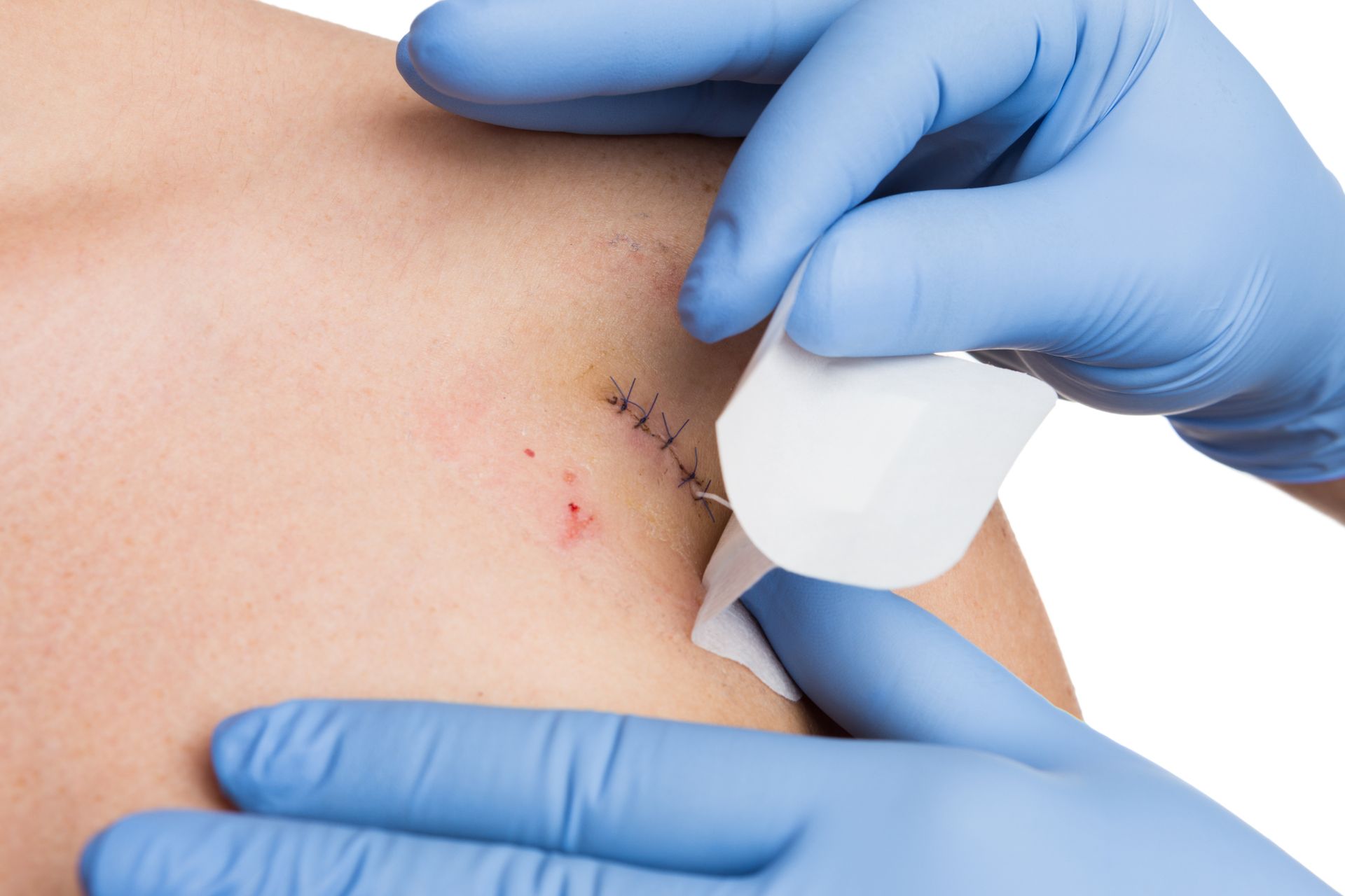 dermatologist applies bandage over stitched wound