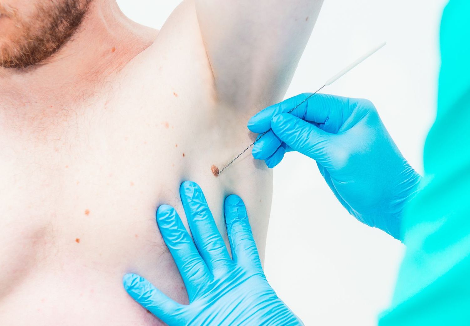 dermatologist scrapes mole on male patients underarm