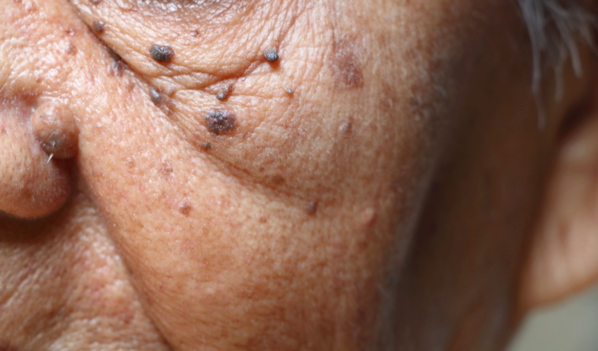 dermatosis papulosa nigra on elderly asian womans cheeks