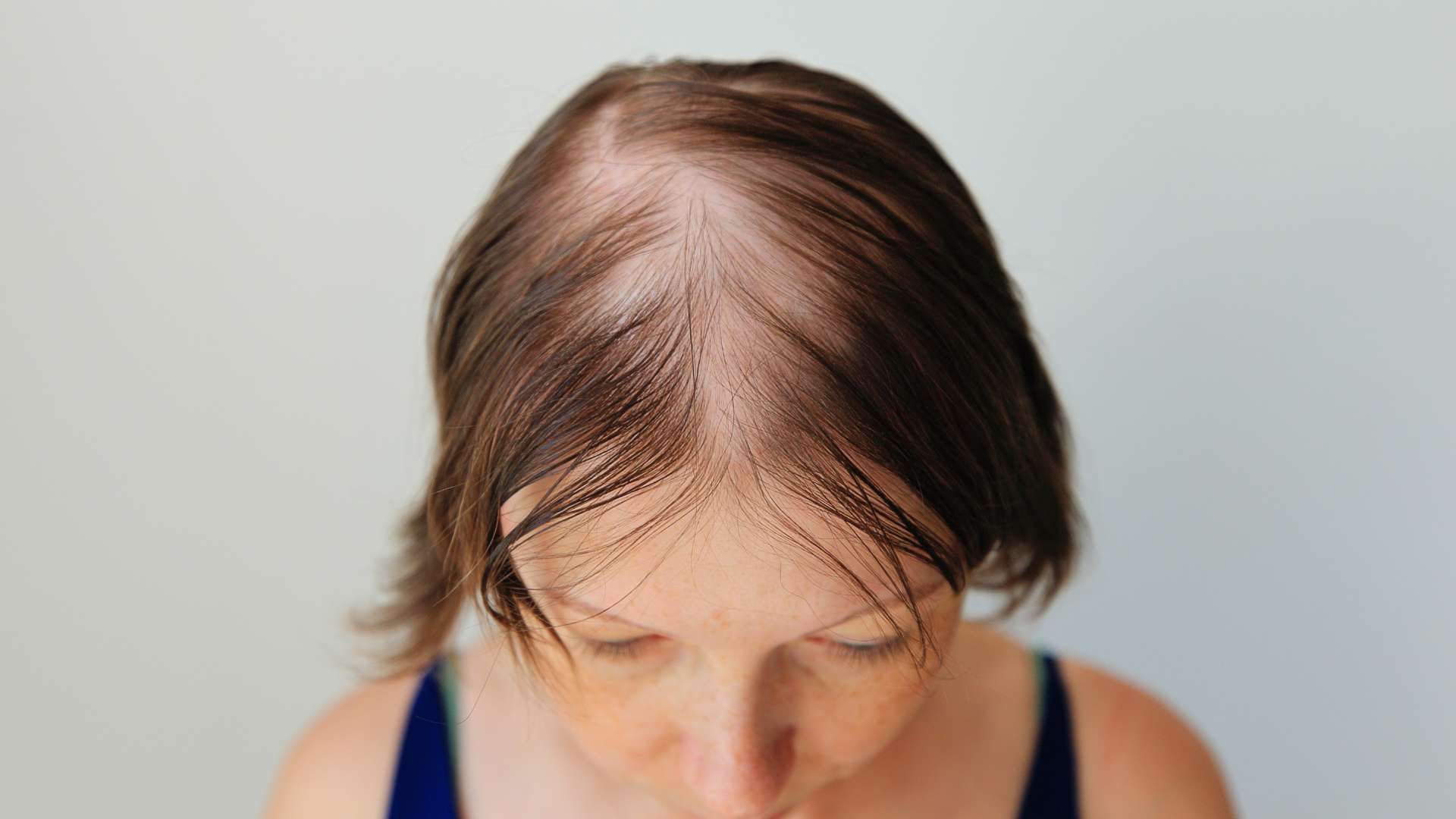Top view of a person with thinning hair and a visible scalp against a light background