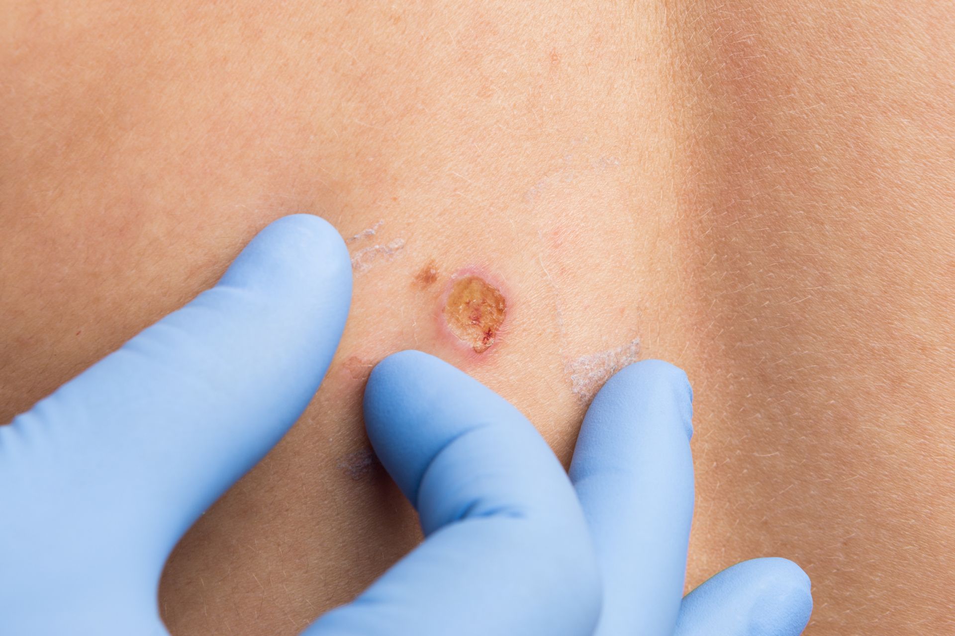 closeup of healing wound after mole removal