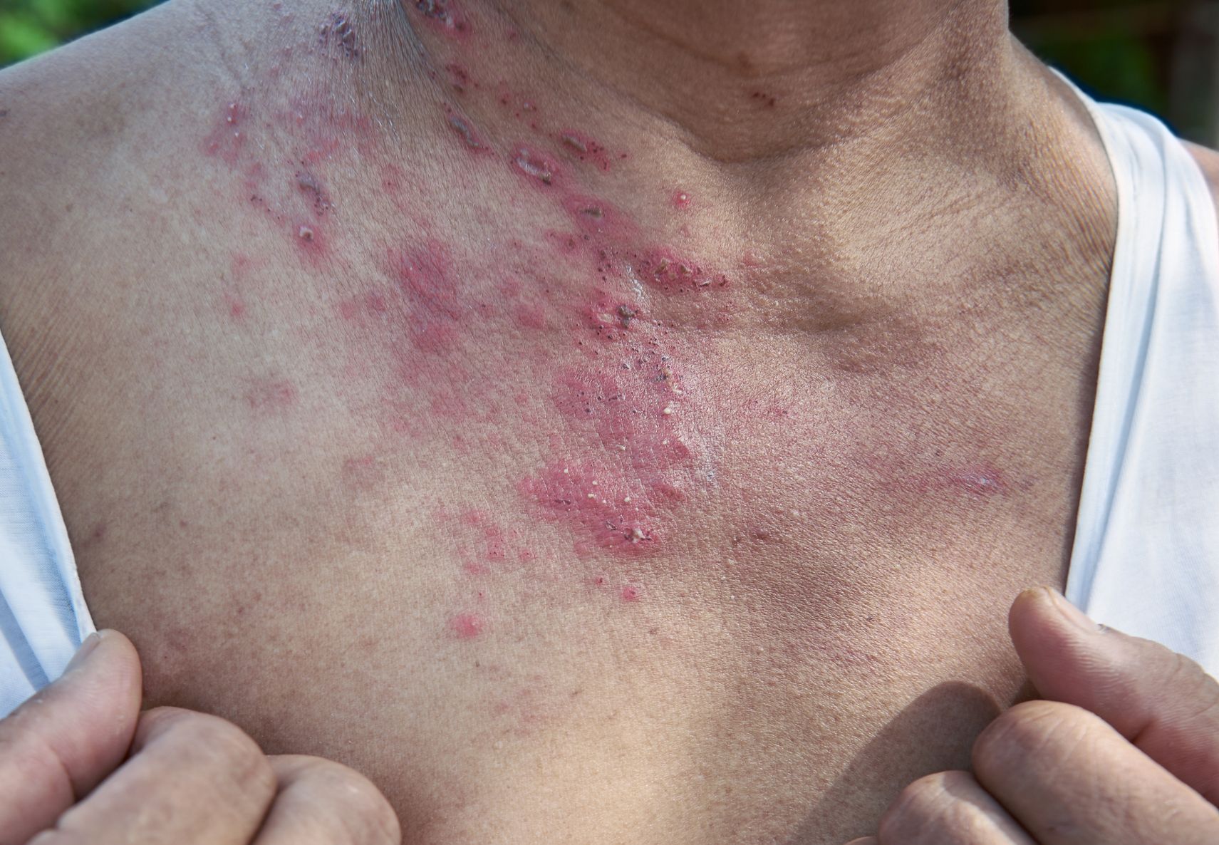 advanced shingles breakout on male patient's neck and chest