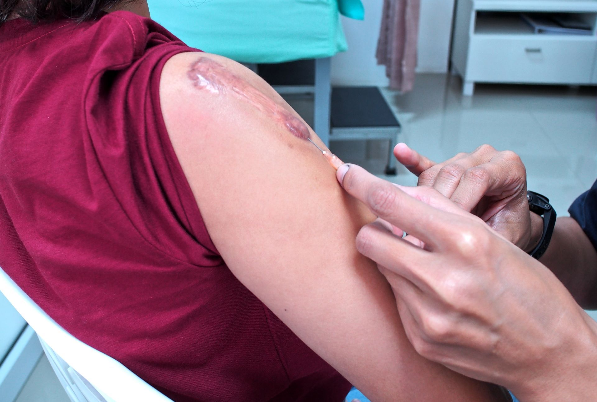 closeup of kenalog injection under skin lesion