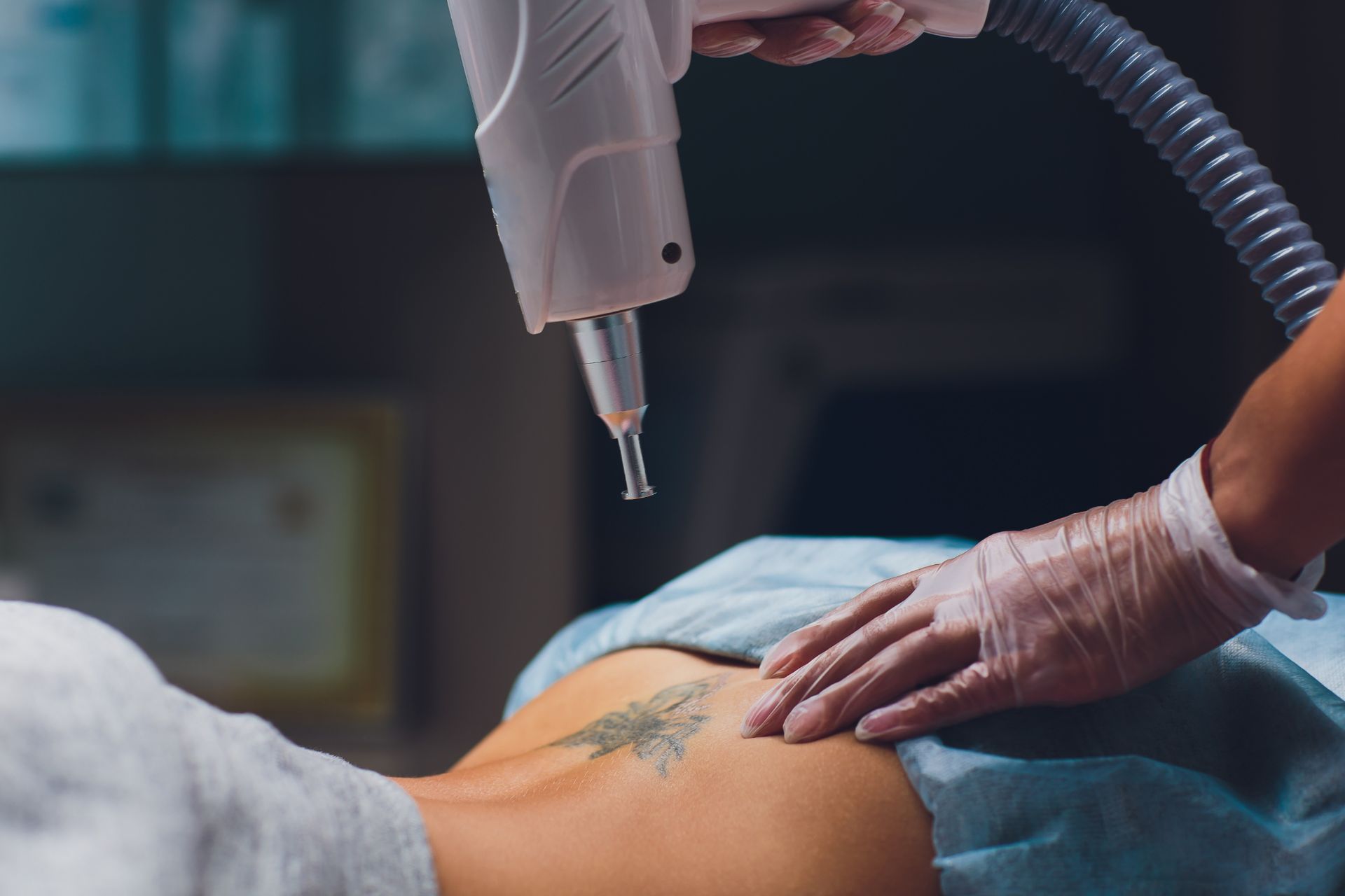 laser tattoo removal on female patient's lower back