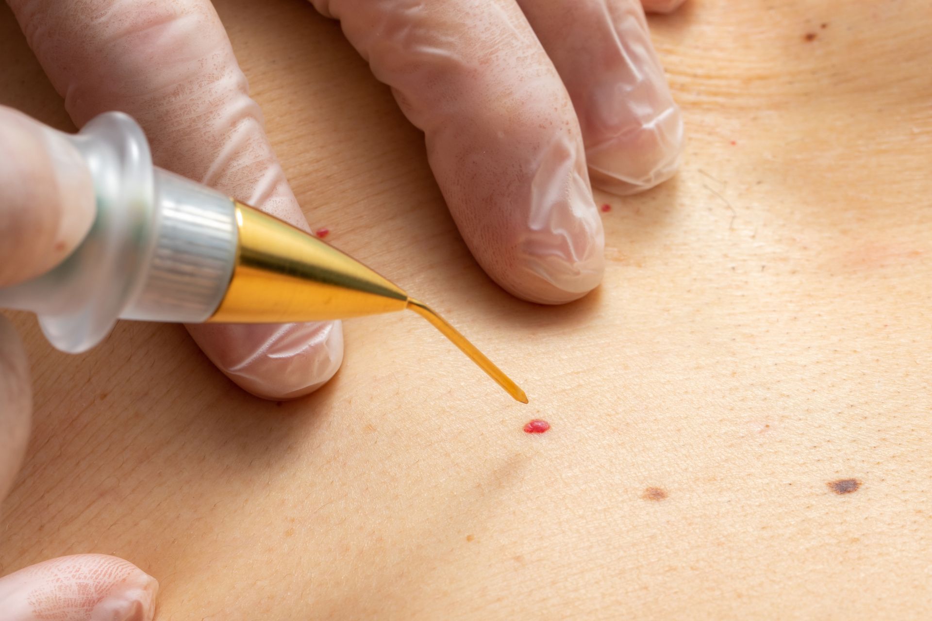 laser skin treatment on cherry angioma