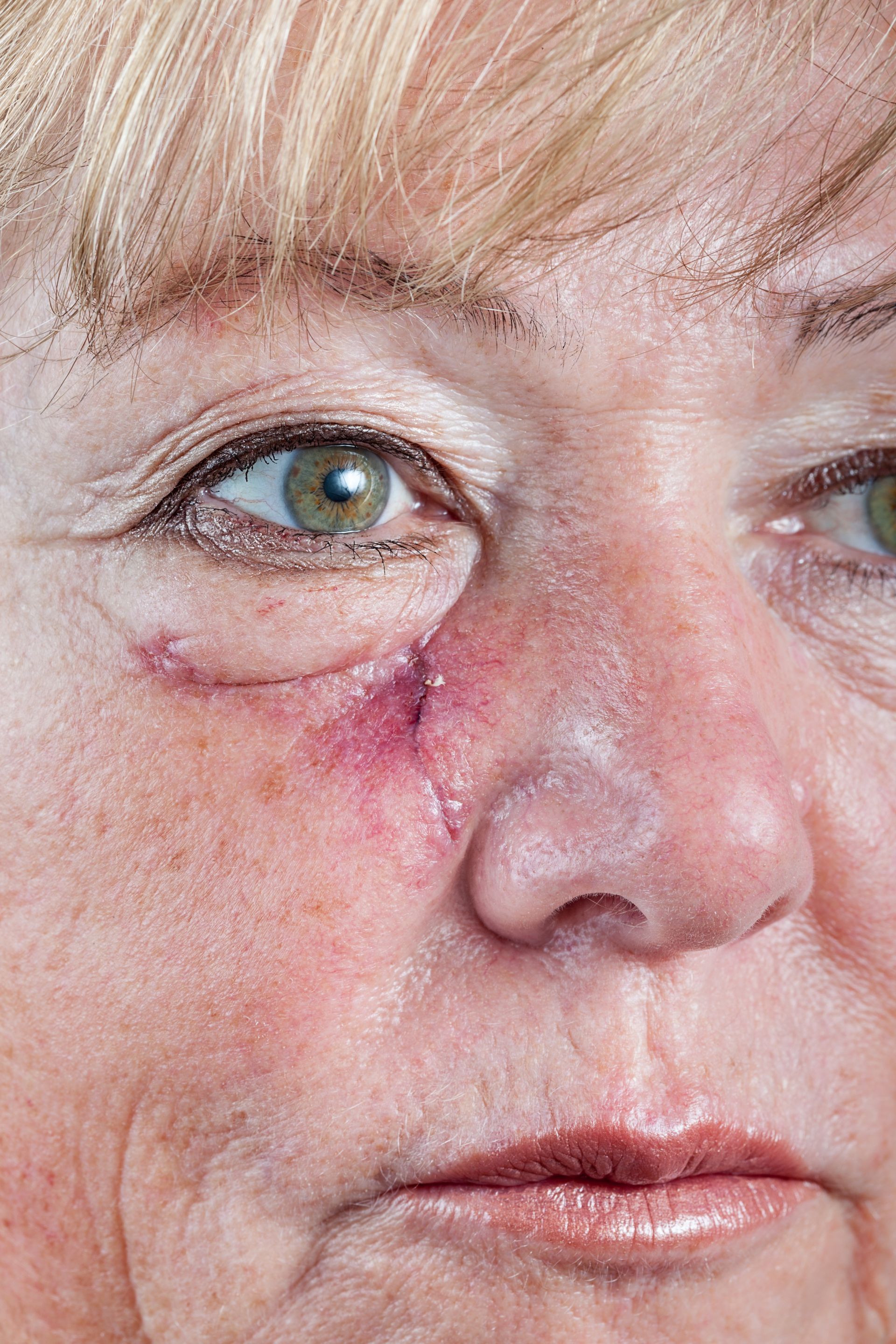 closeup of healing wound on woman's face after mohs surgery