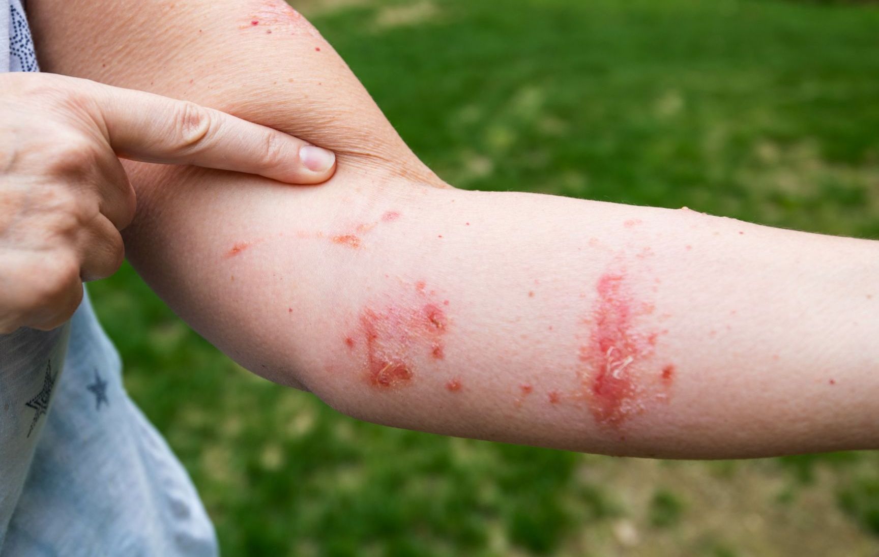 closeup of ringworm rash on white patient's leg