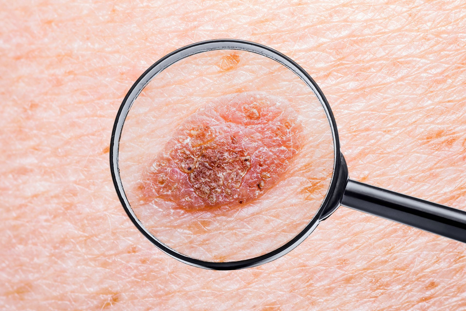 Magnifying glass examining a red, scaly skin lesion