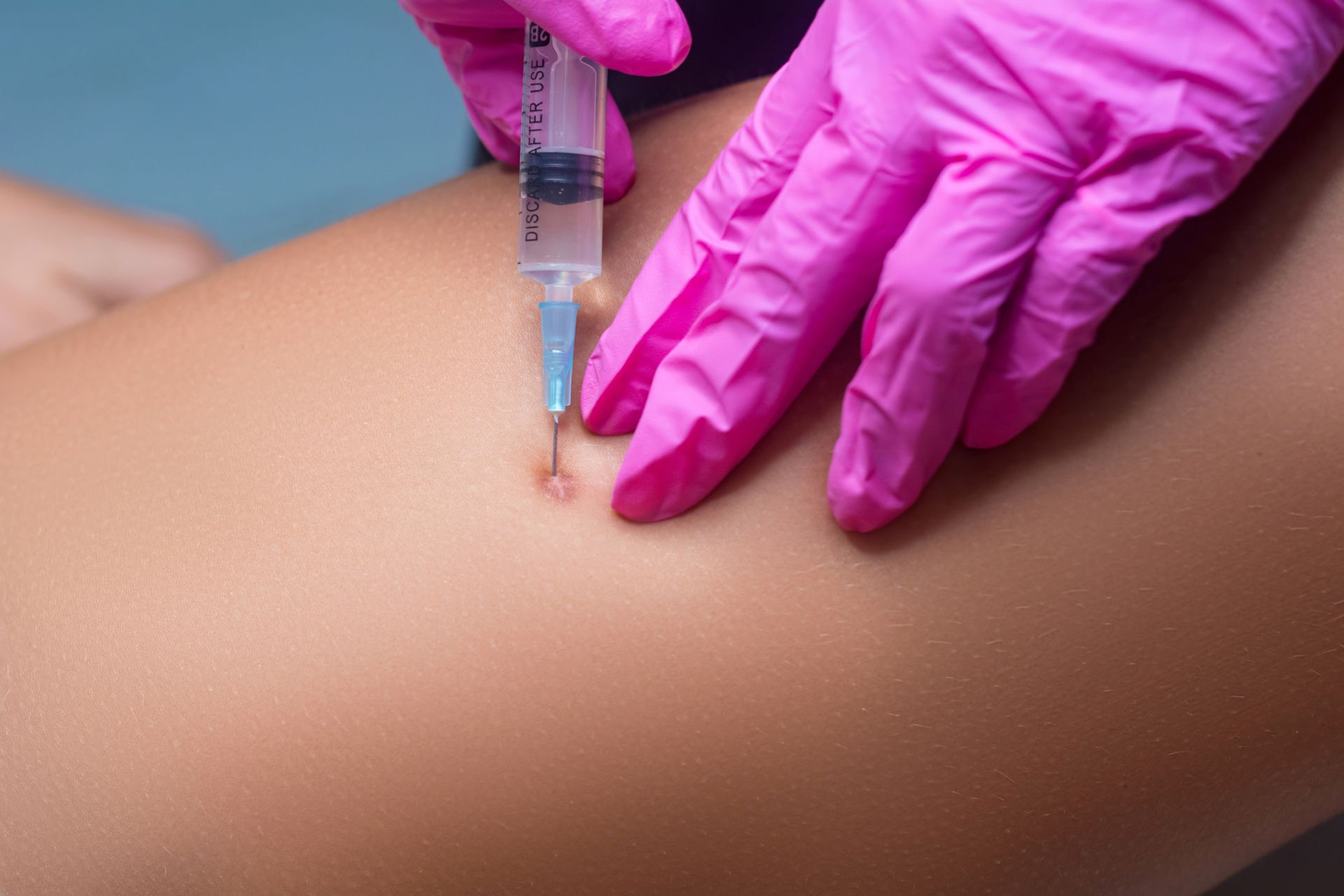 closeup of kenalog injection under skin lesion