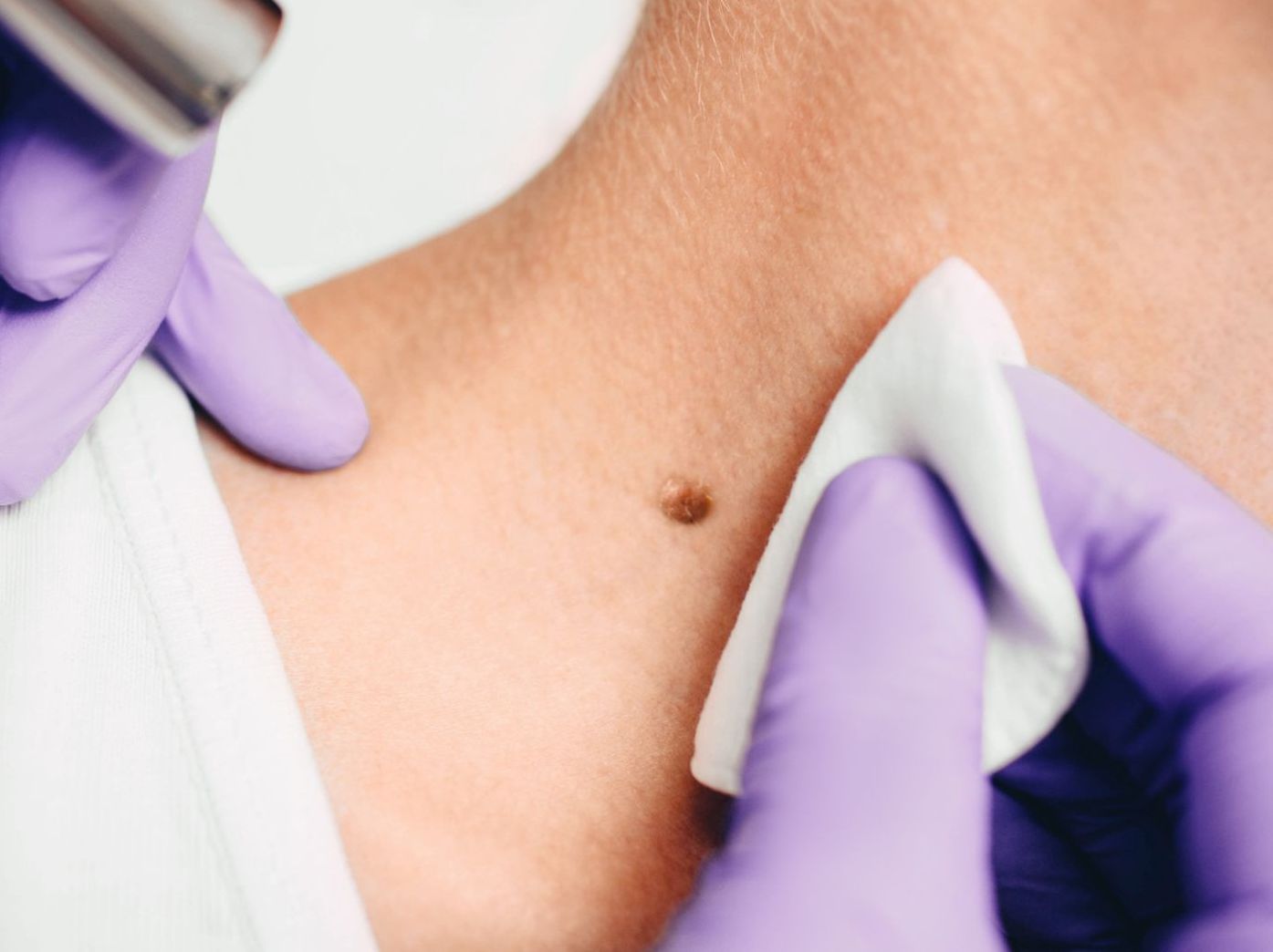 laser removal of nevi birthmark on neck