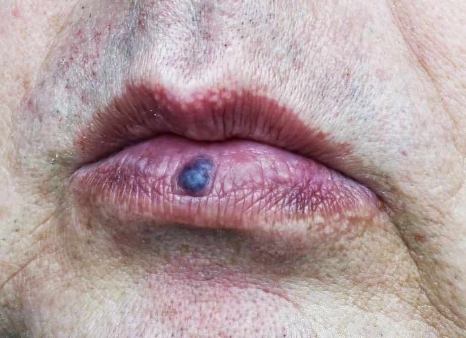 venous lake on senior patient's lip