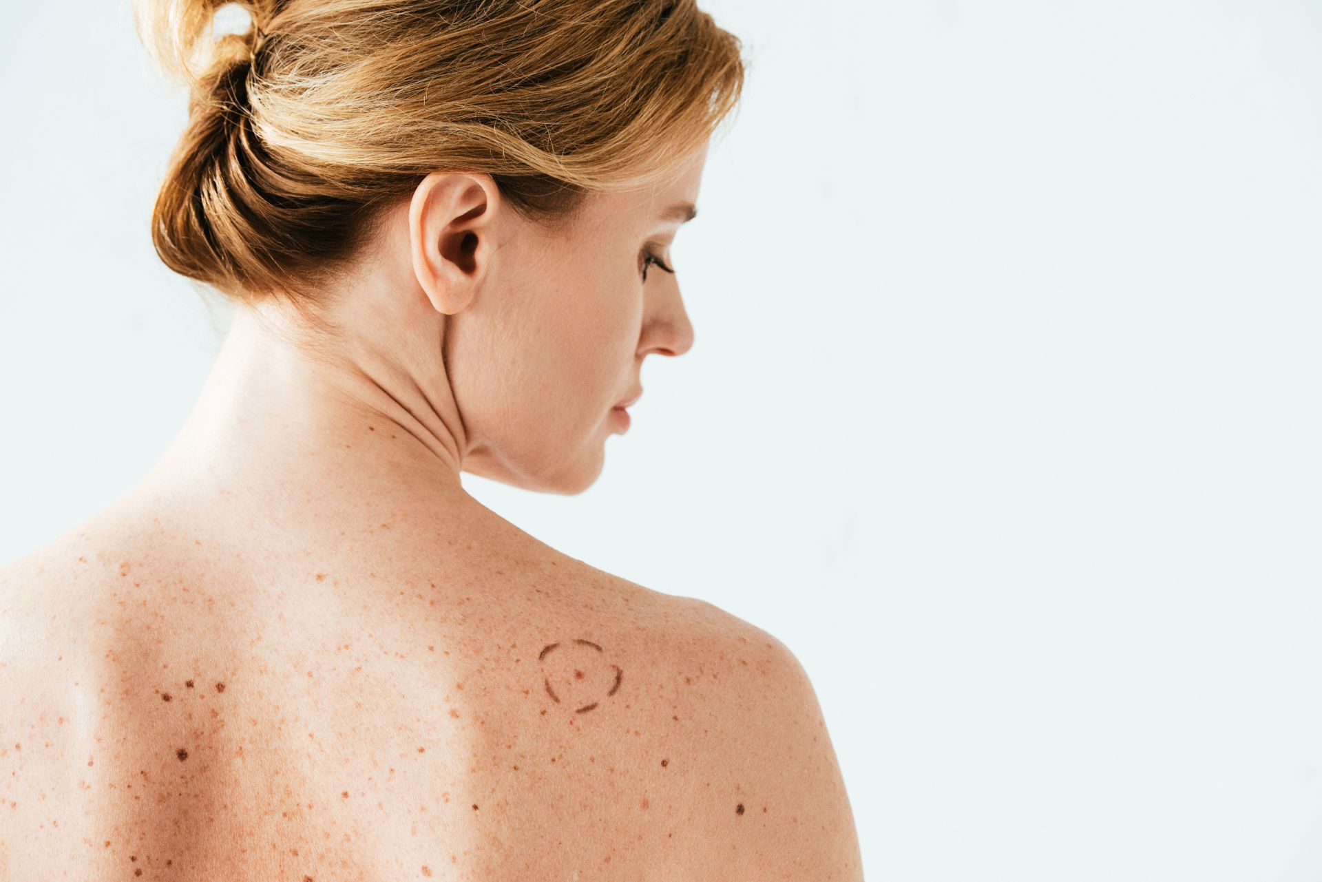 white female patient with circled back mole