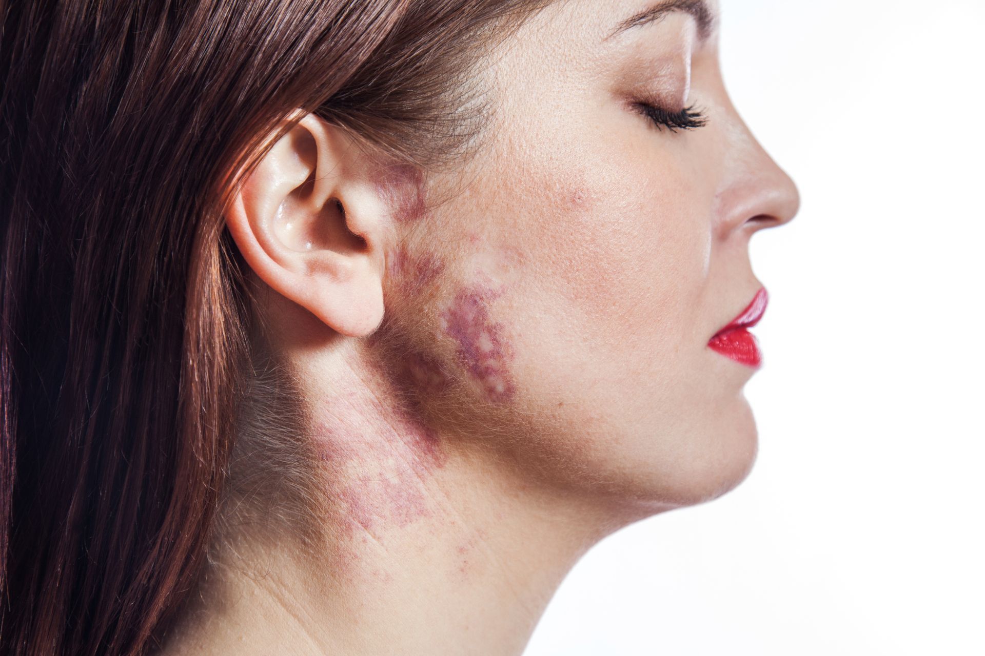 white woman with large port wine stain face