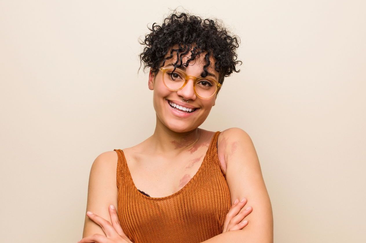 young african-american woman large birthmark shoulder