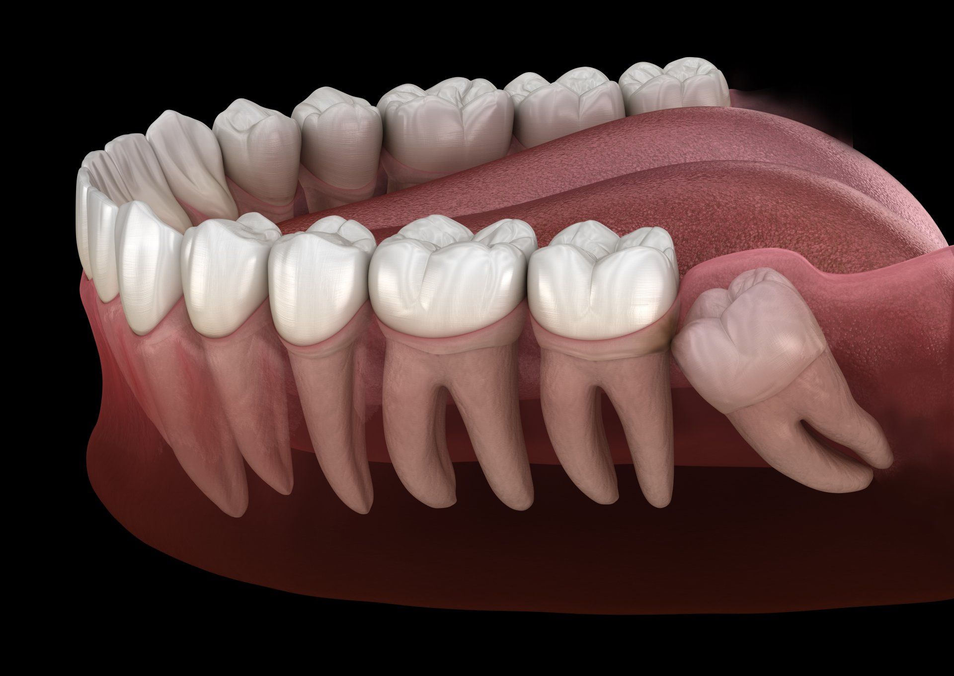 wisdom teeth compacted model.