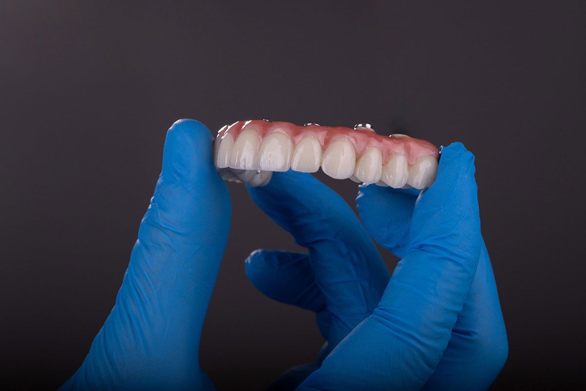 Full-Arch Tooth Replacement in Riverview, Comparing Denture and Implant Options