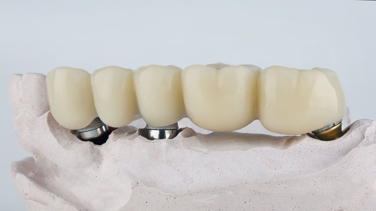 Implant Bridges in Riverview, Replacing Multiple Teeth With Precision and Stability