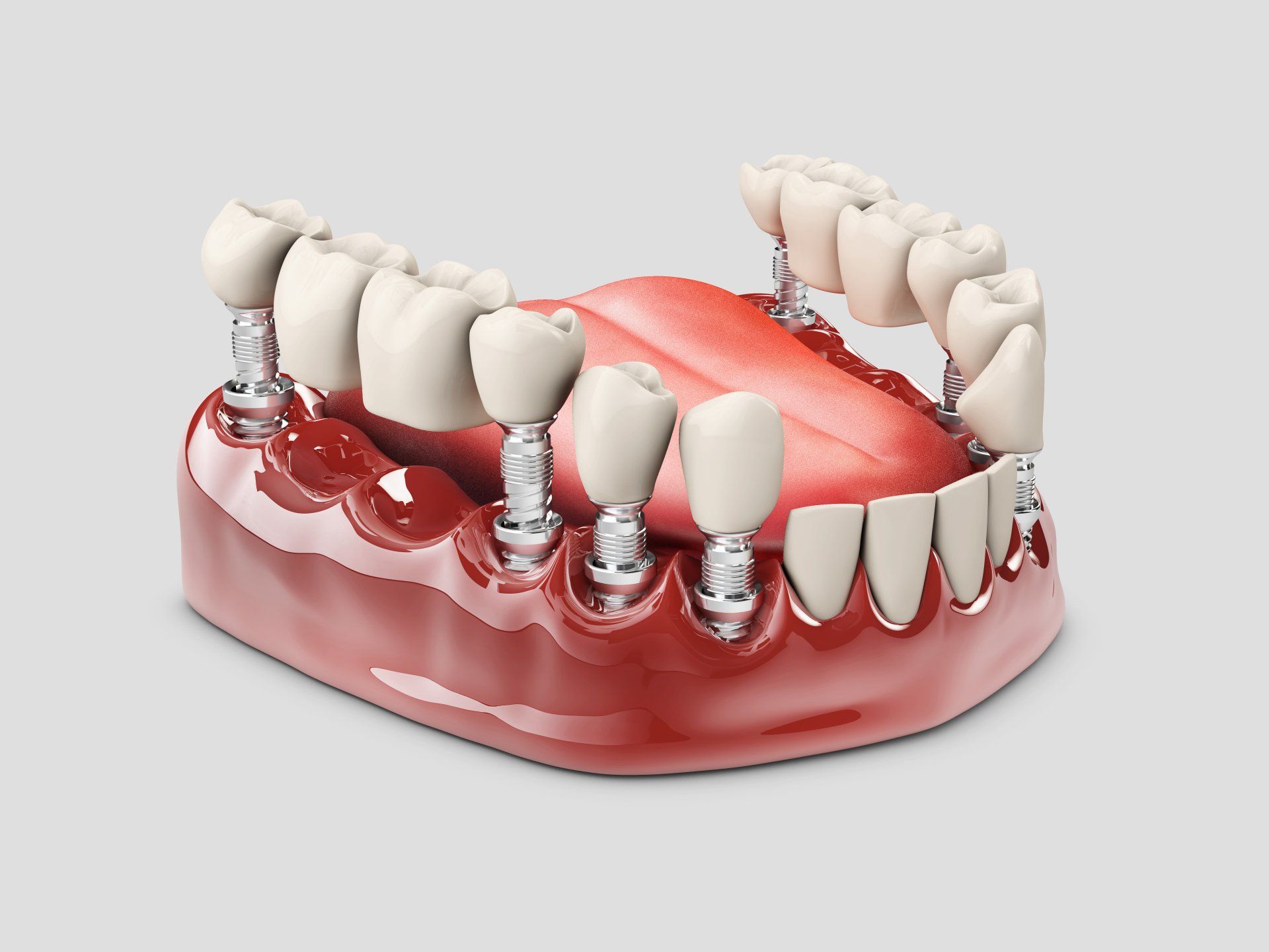 model of an implant bridge showing the implant and the teeth that are a bridge.