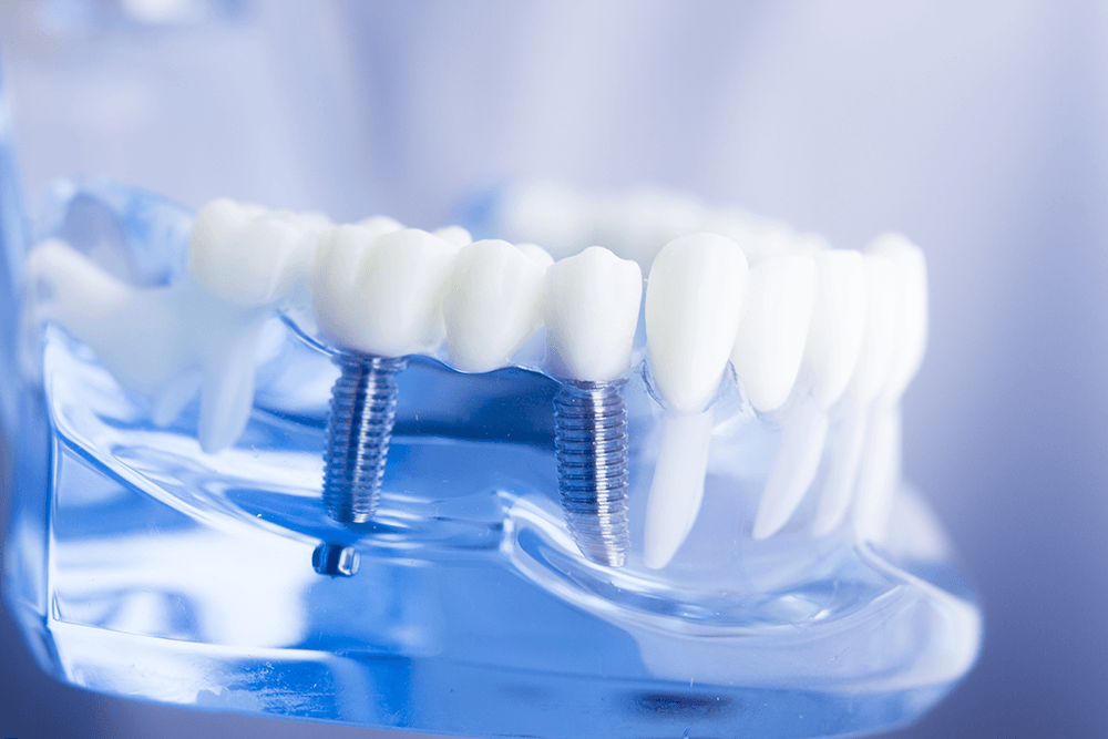 model of implants in teeth to illustrate how you could need implants for a bridge.