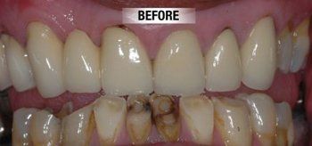 Before Restoration of Worn Down Teeth — Bunbury WA — FADC Dental Group