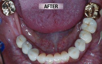 After Replacing Broken Old Crown — Bunbury WA — FADC Dental Group