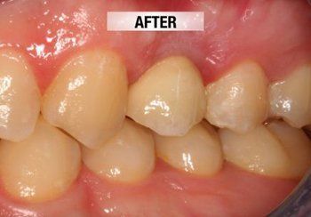 After Surgery and Prosthetics — Bunbury WA — FADC Dental Group
