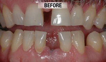 Before Prosthetics — Bunbury WA — FADC Dental Group