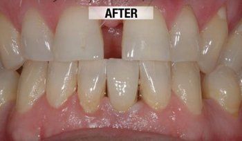 After Prosthetics — Bunbury WA — FADC Dental Group