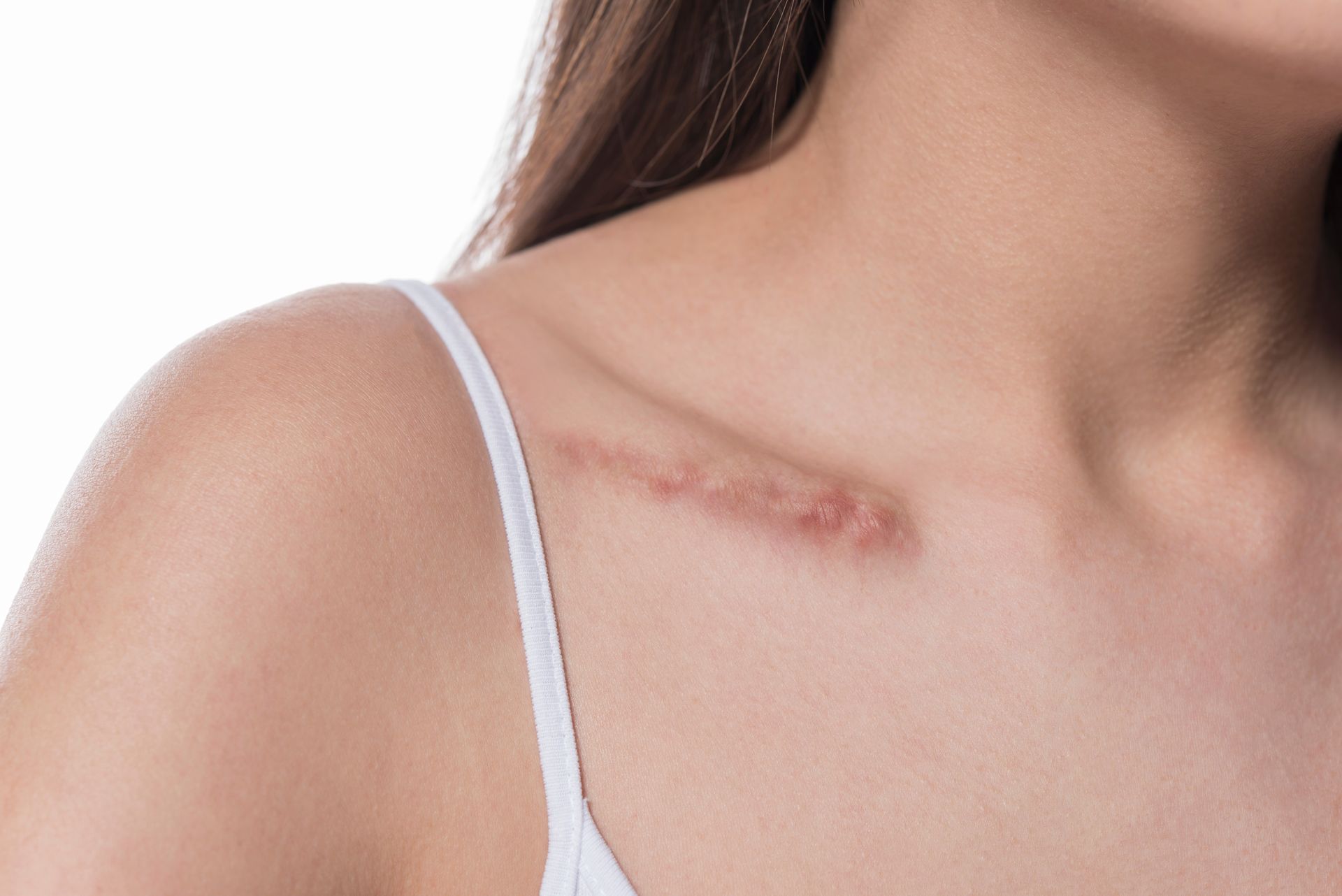 Close-up of a shoulder with a healed scar near the collarbone