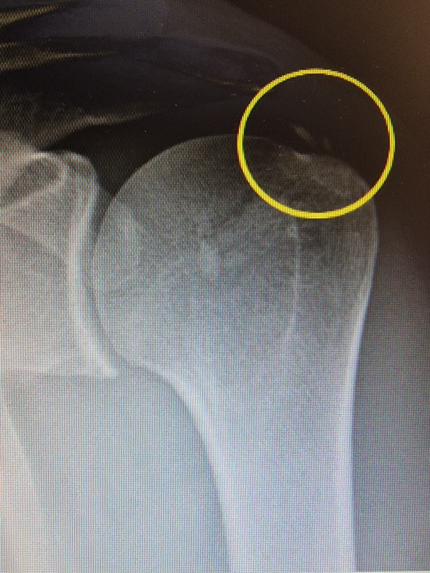 calcificazione spalla