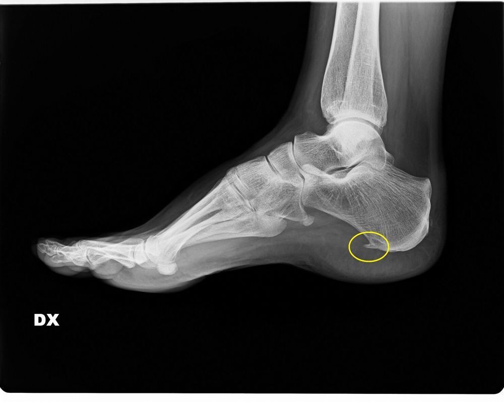 sperone calcaneare