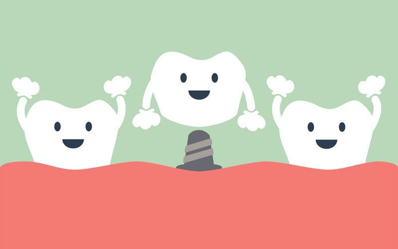 Dental Implant Visual Image — Nashville, TN — Scott Nickels, DDS Dental Implant Visual Image — Nashville, TN — Scott Nickels, DDS
