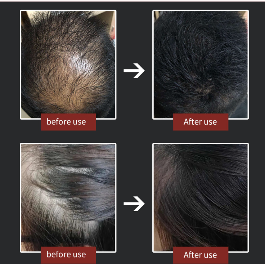 Face Lift Threading