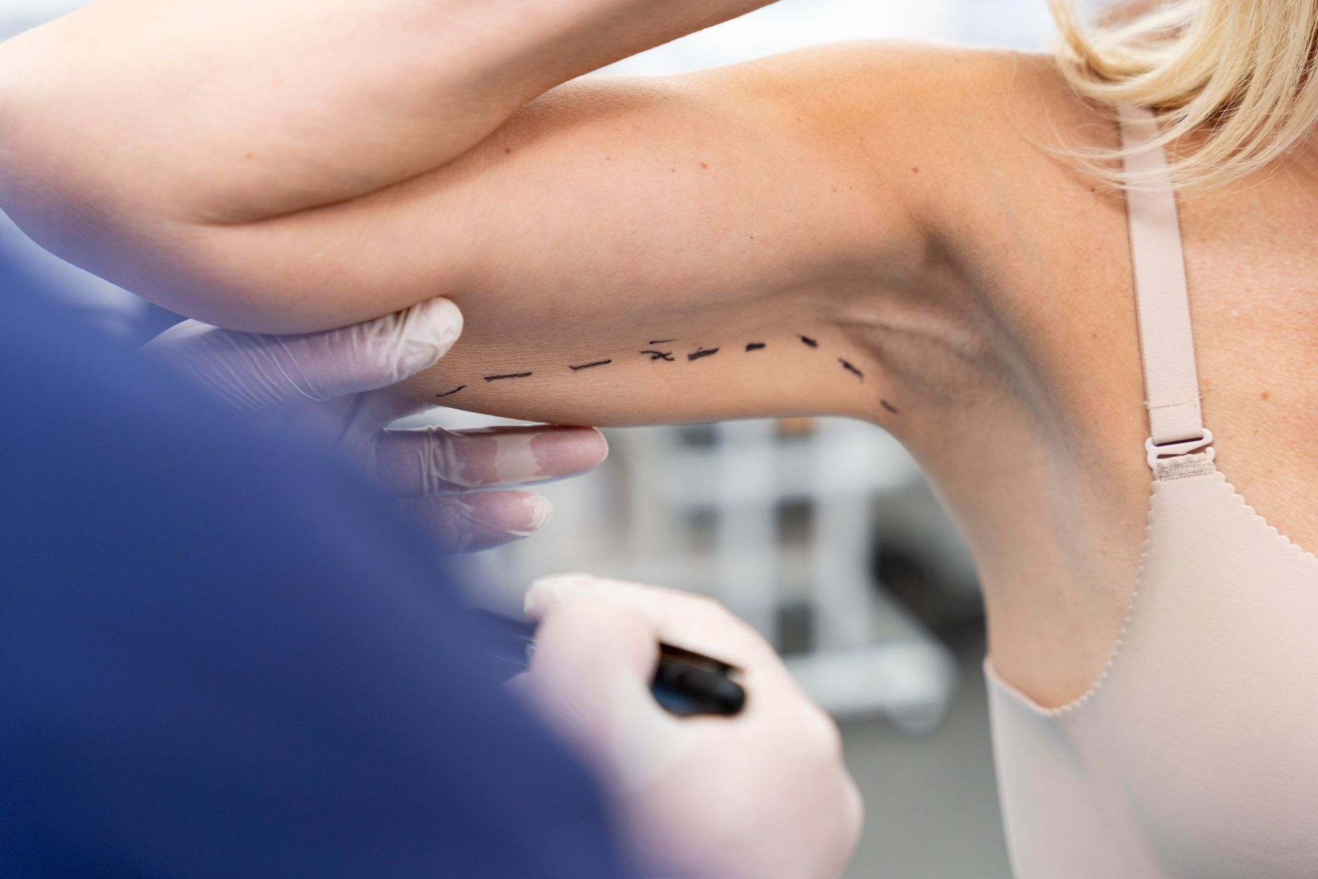 a woman 's arm with lines drawn on it