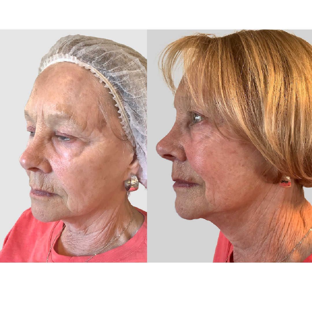 facial fillers before vs after