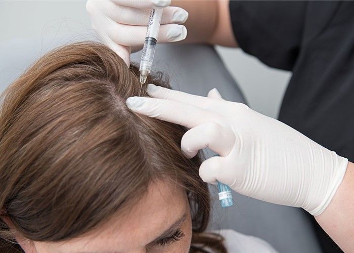 prp hair treatment Burlington ON