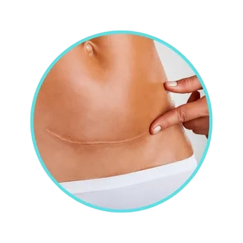 Stretch mark camouflage Pittsburgh Effortless Beauty PGH