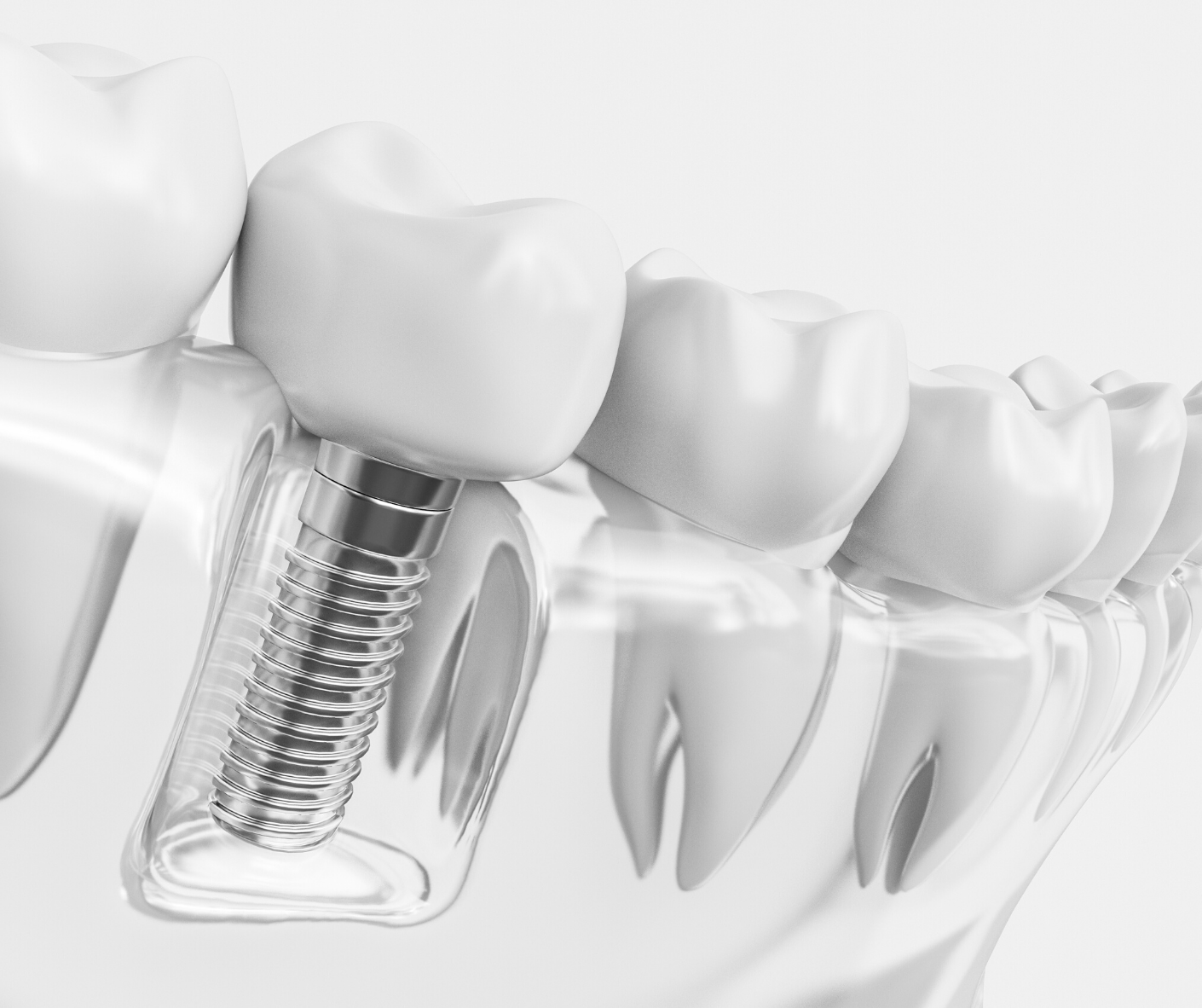 Dental implant illustration, showing a screw-like implant in the jawbone supporting a crown, with surrounding teeth.