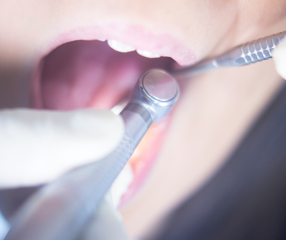 Dental tools in a patient's mouth; a dental drill and explorer are visible.