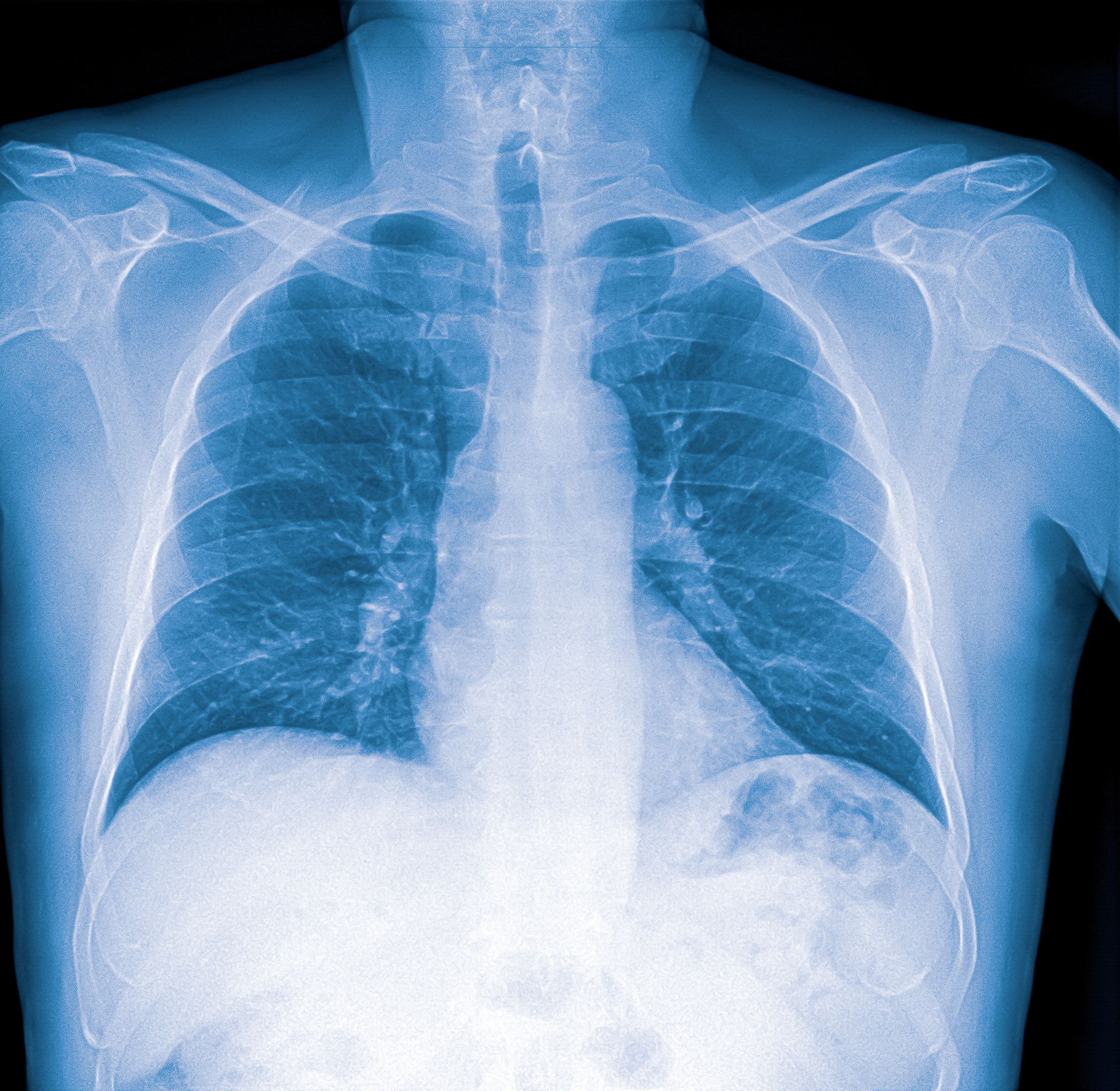 radiografia dei polmoni