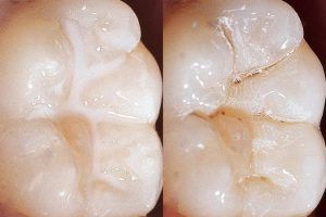 Dental Sealants - Christiana Pleasant Dental