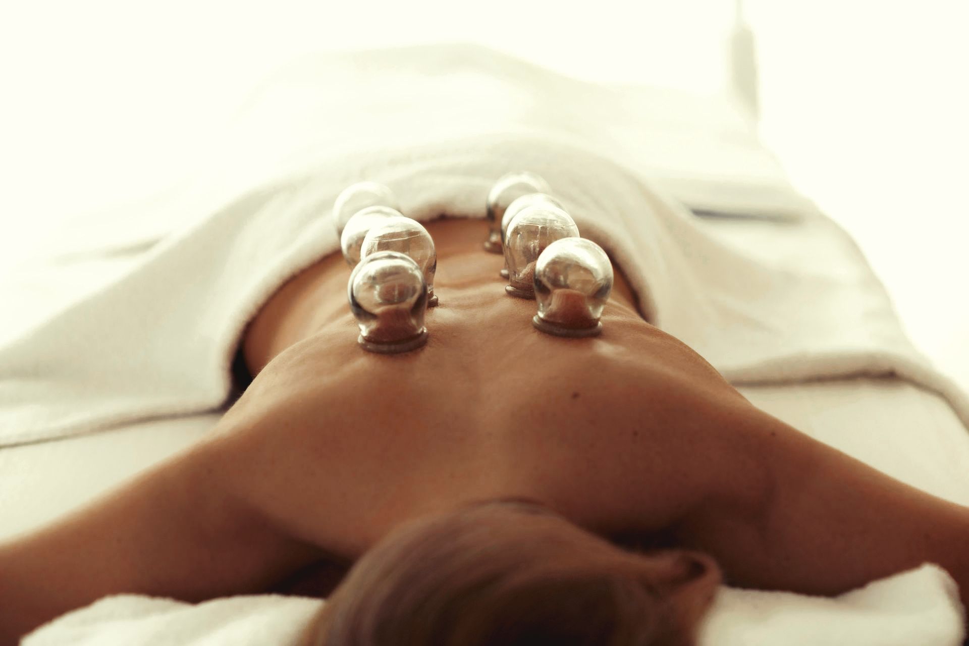 A woman is laying on a bed with cupping cups on her back.