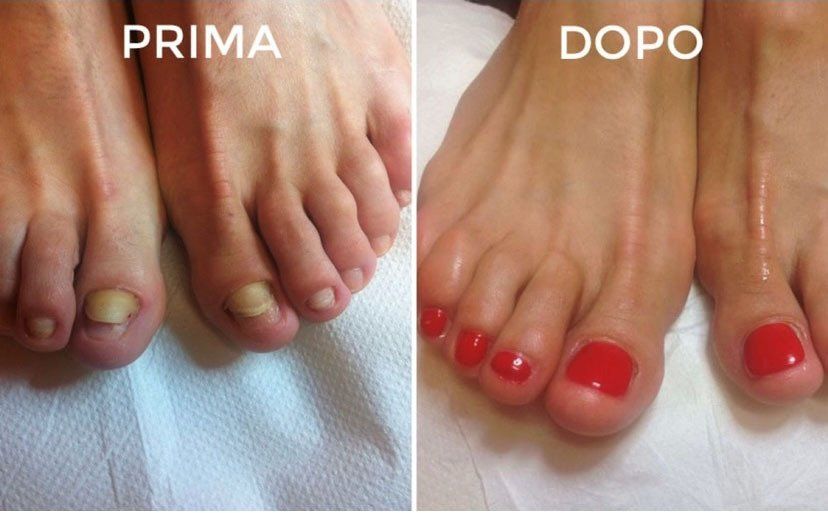 Prima e dopo, primo piano di piedi con unghie verdi, poi smalto rosso per pedicure.