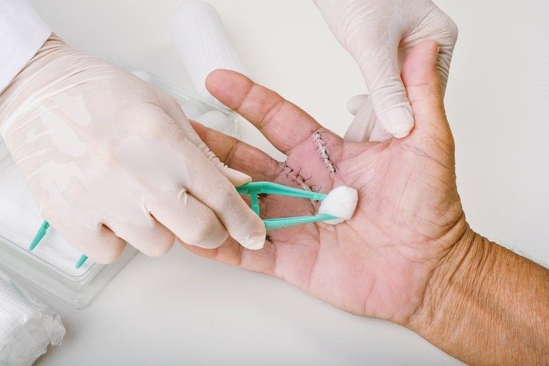 A doctor is cleaning a patient 's hand with a cotton ball and tweezers - Home Health in Chadds Ford, PA