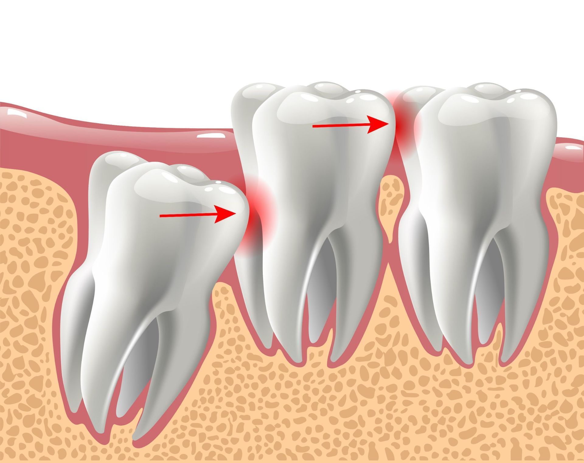 Wisdom Tooth Problems — Dental Services in Gracemere, QLD