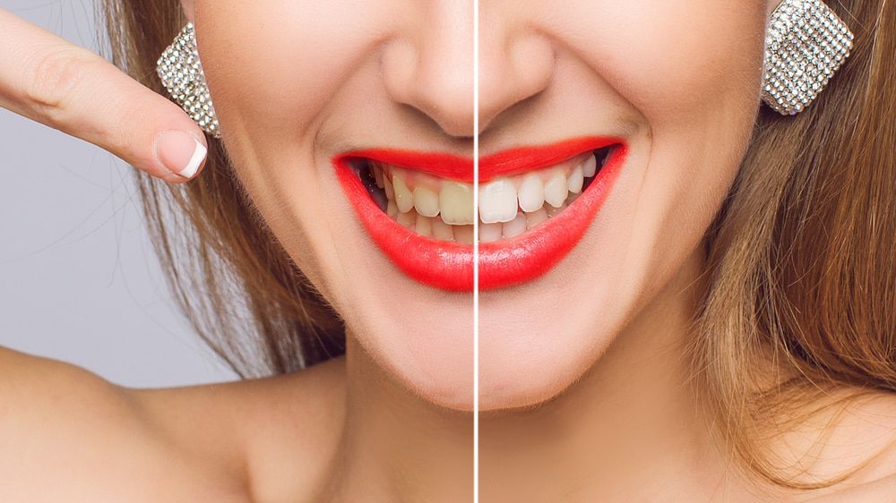 Woman Teeth Before And After Dental Treatment — Dental Services in Gracemere, QLD