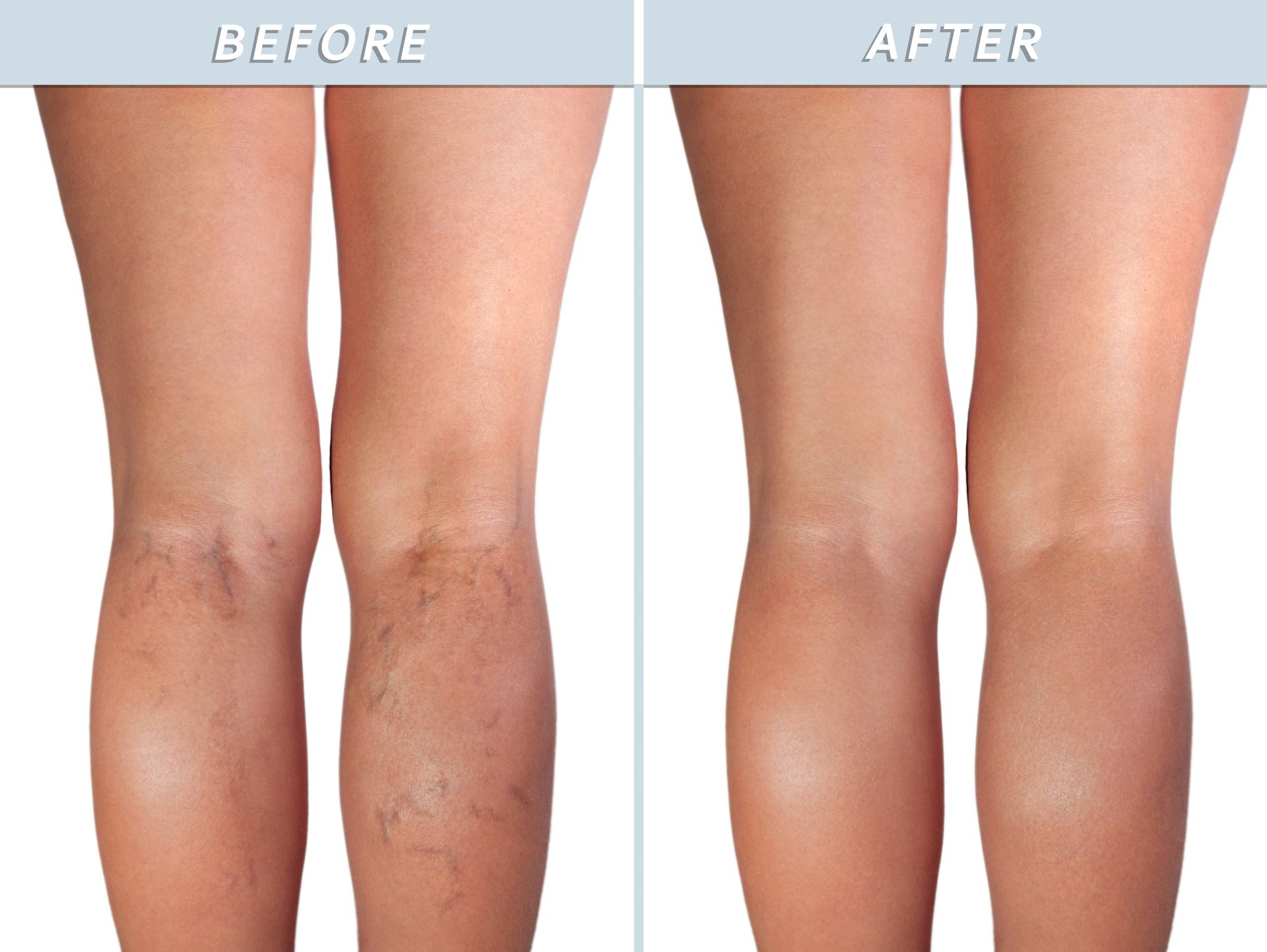 A before and after photo of a woman 's legs with varicose veins