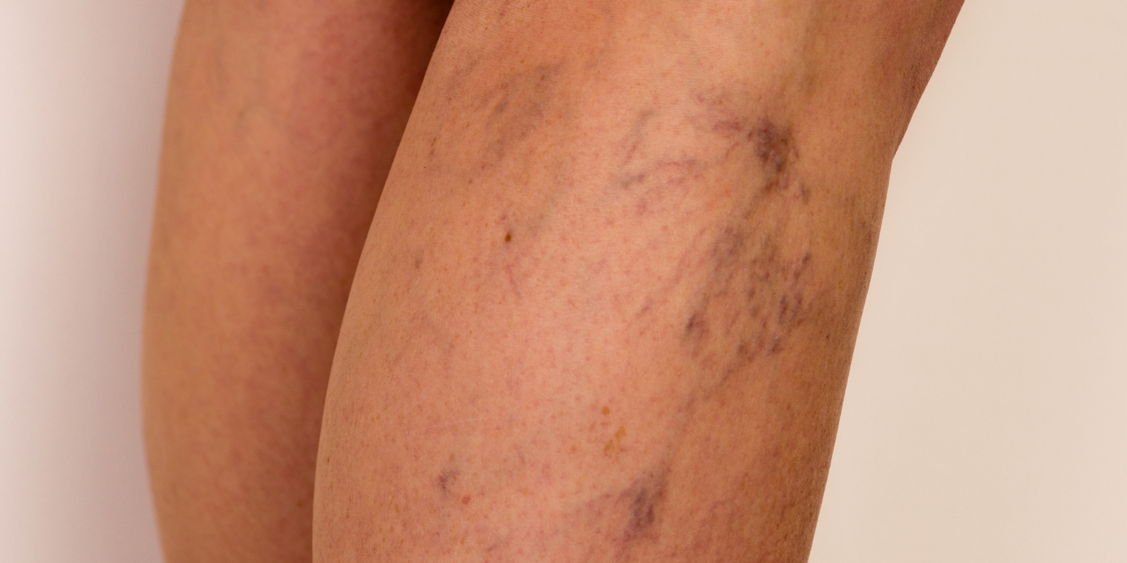 Close-up of a forearm with dark bruising and scratches near the elbow
